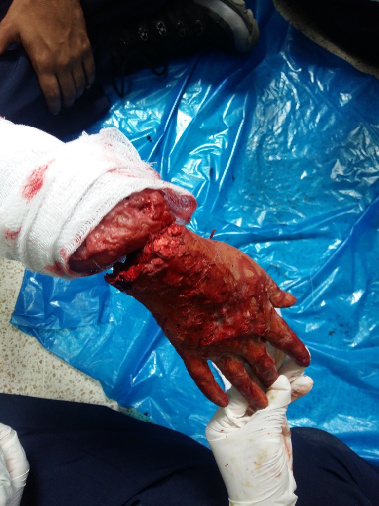 Mano herida con vendaje y sangre visible sobre una superficie azul.