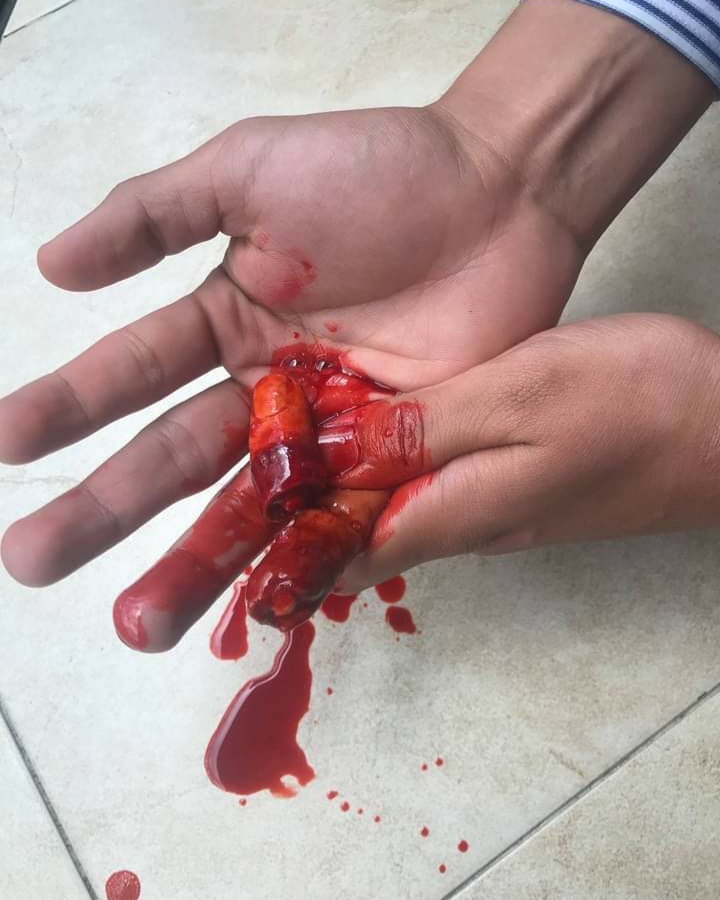 Close-up of a hand with simulated blood and wounds, demonstrating a trauma scenario for educational purposes.